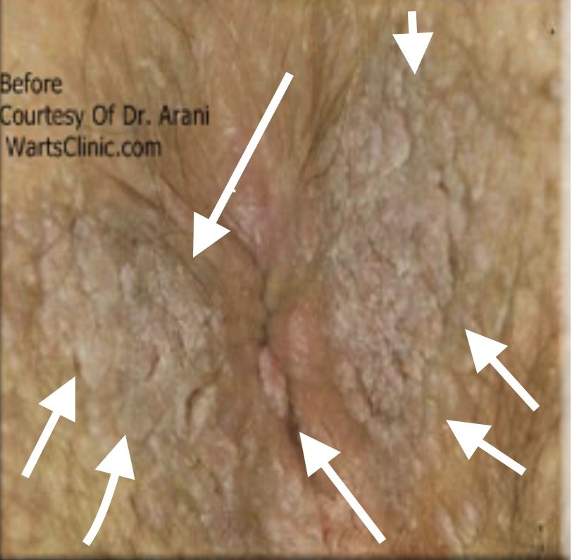 Anal, Perianal & Perineum HPV Tumors – photo 2