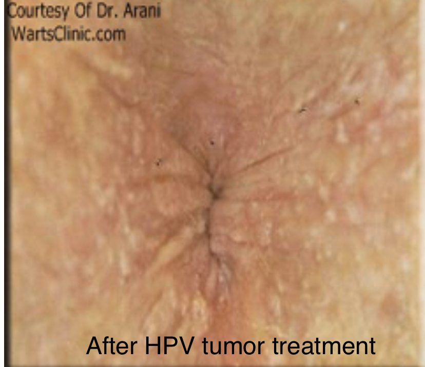 Anal, Perianal & Perineum HPV Tumors – photo 3