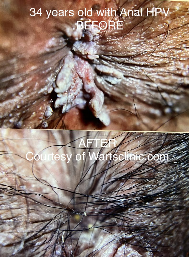 Anal, Perianal & Perineum HPV Tumors – photo 4