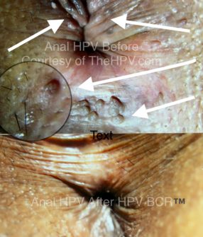 Anal, Perianal & Perineum HPV Tumors – photo 5