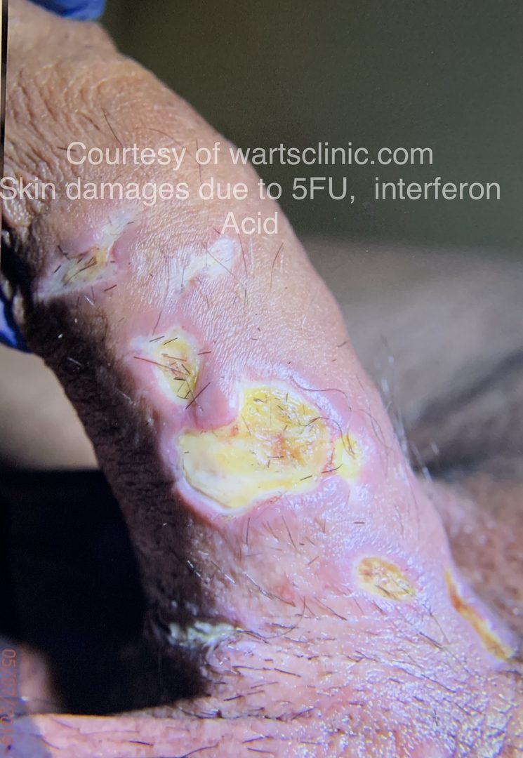 Failed Wart Treatments – photo 1