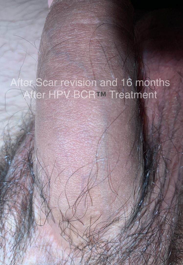 Failed Wart Treatments – photo 2
