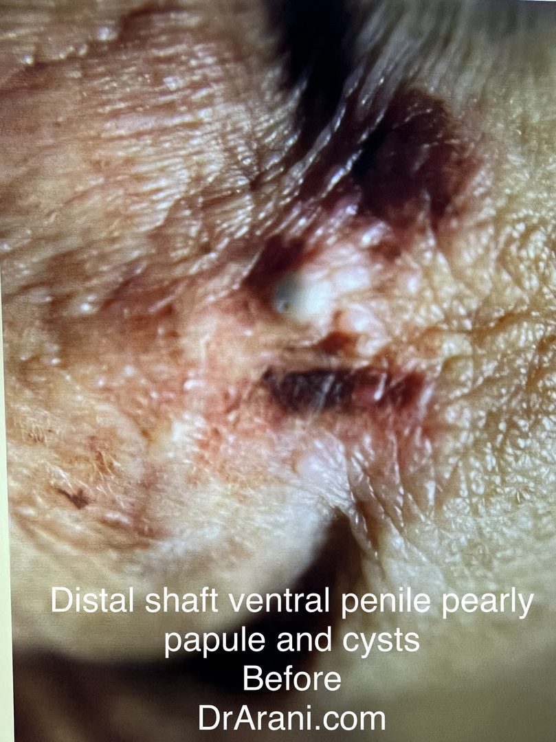 Genital Plastic Surgery – photo 1