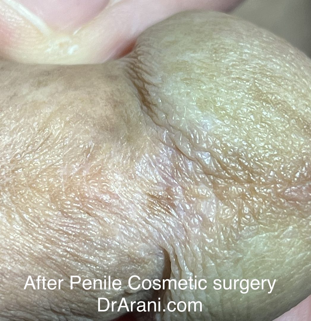 Genital Plastic Surgery – photo 2