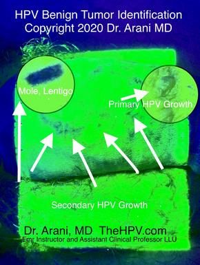 HPV BCR™ Wart Identification & Mapping Step – photo 1