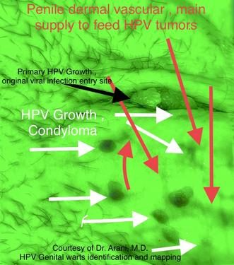 HPV BCR™ Wart Identification & Mapping Step – photo 2