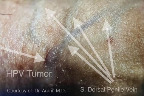 HPV BCR™ Wart Identification & Mapping Step – photo 3