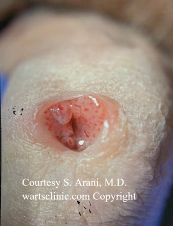 Urethral HPV Warts & Tumors – photo 1