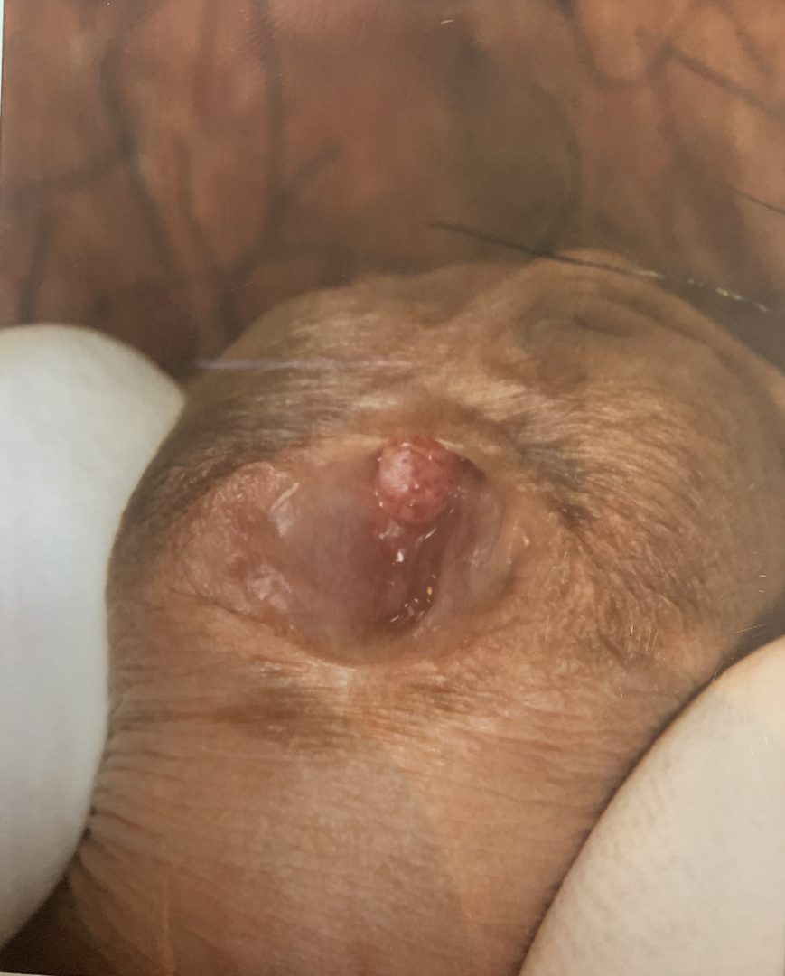 Urethral HPV Warts & Tumors – photo 10