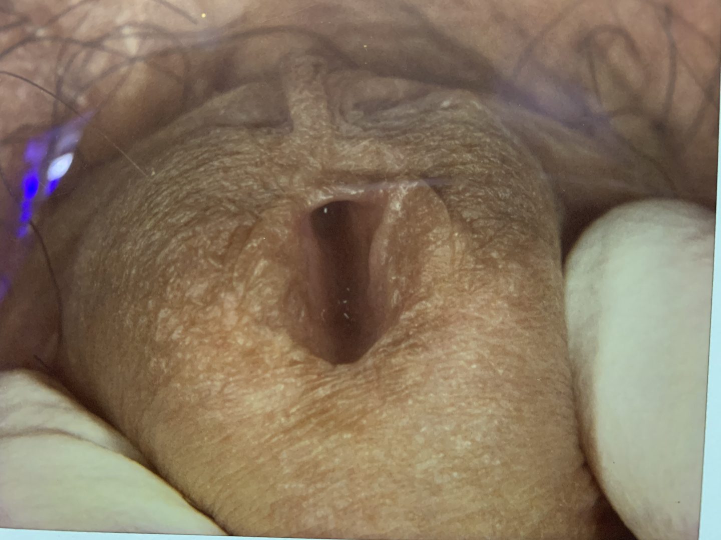 Urethral HPV Warts & Tumors – photo 11