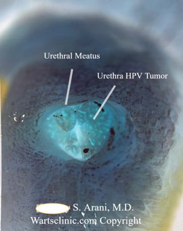 Urethral HPV Warts & Tumors – photo 2