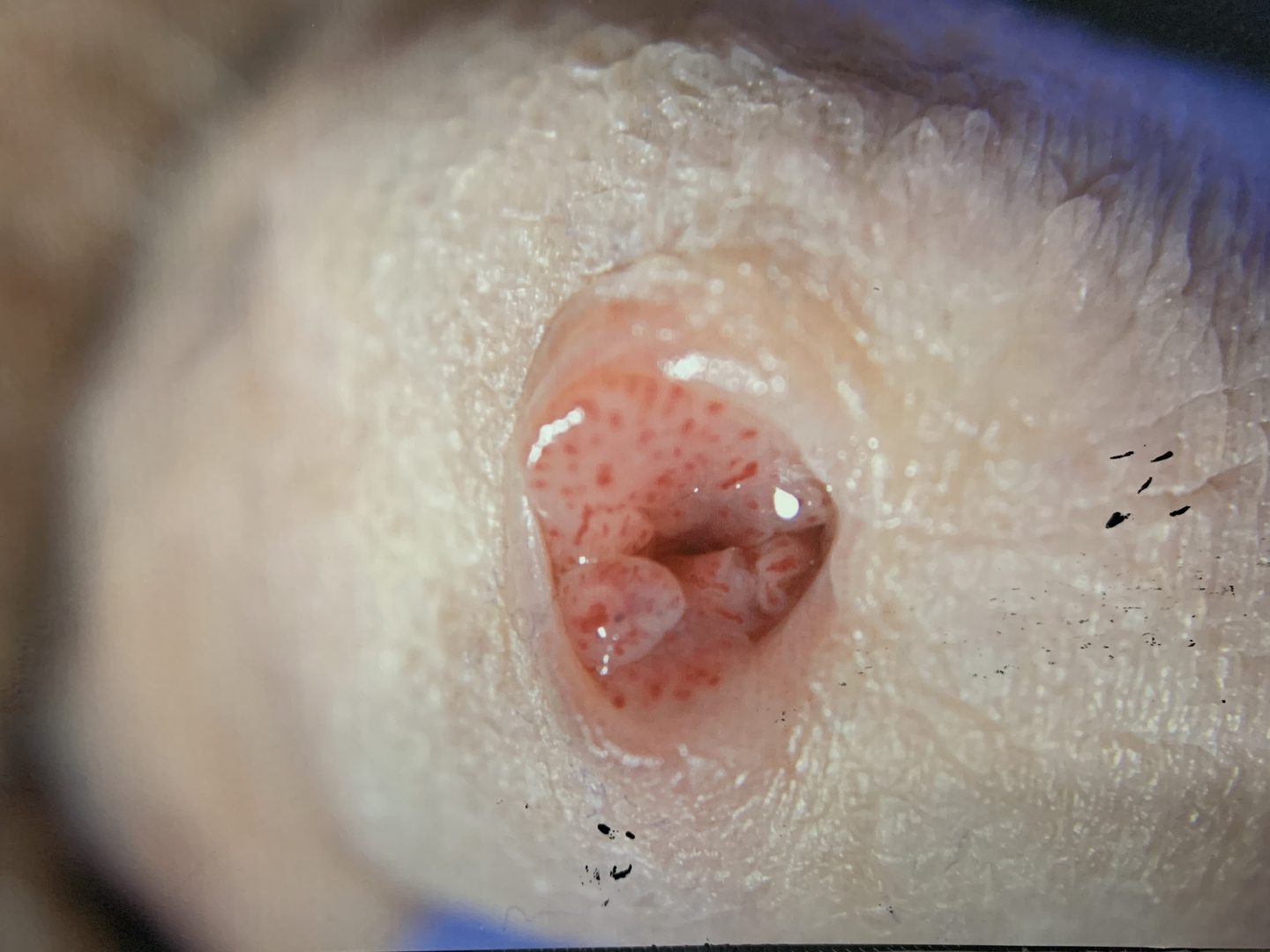 Urethral HPV Warts & Tumors – photo 3
