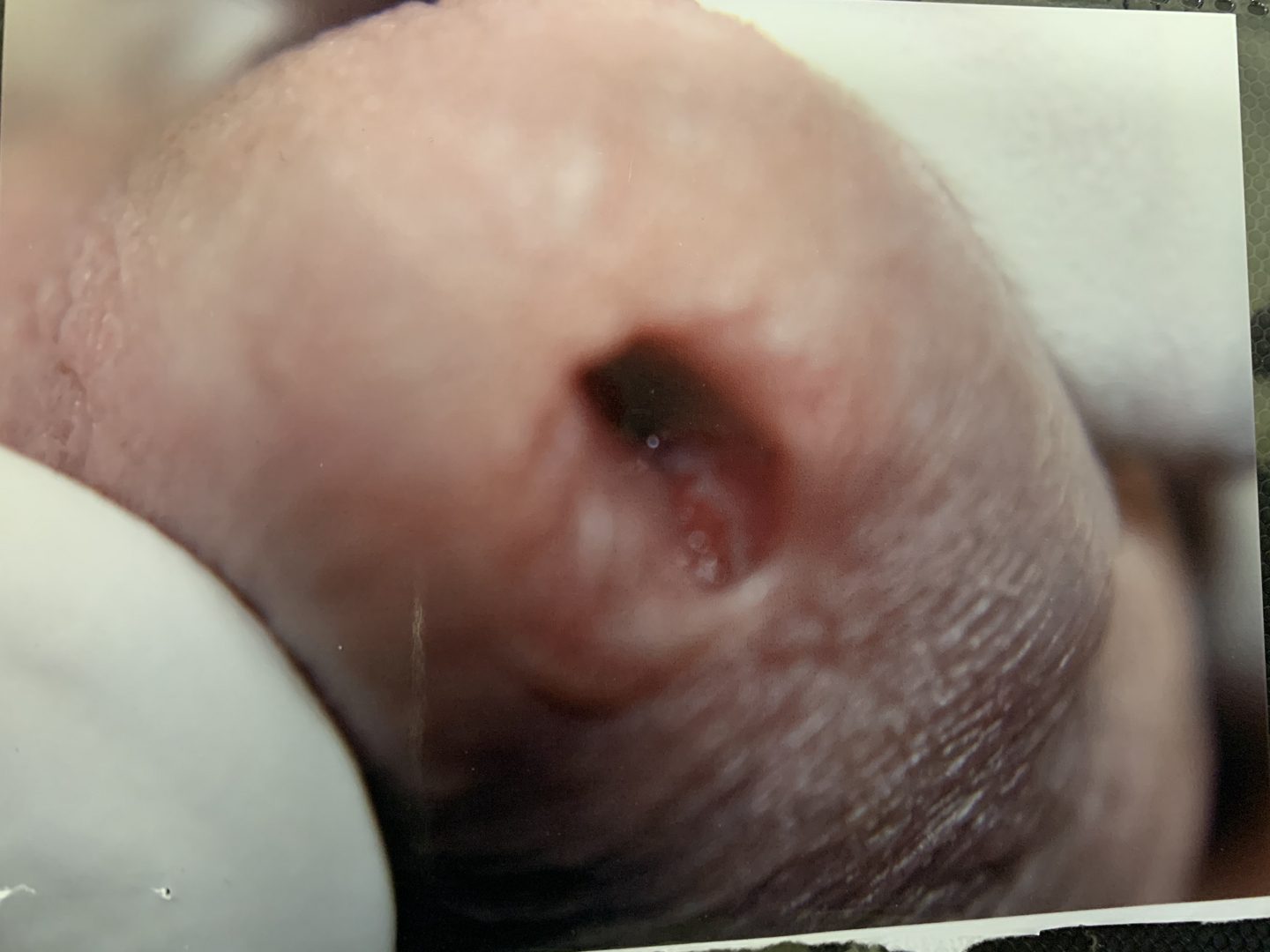 Urethral HPV Warts & Tumors – photo 4