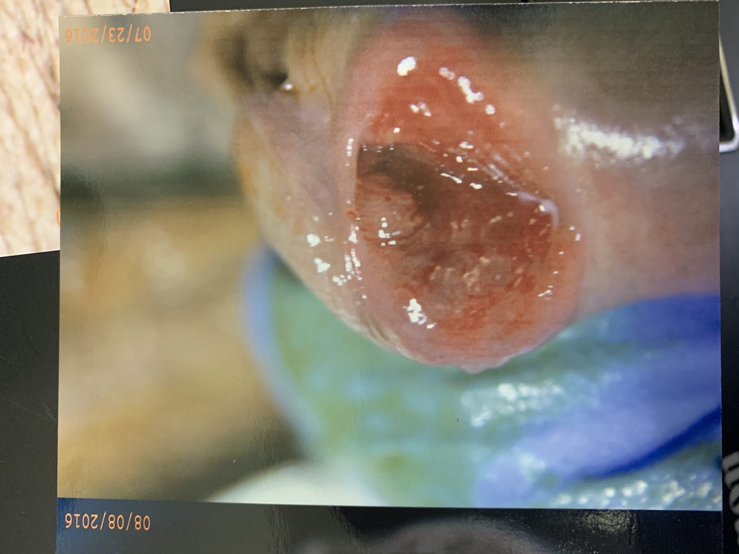 Urethral HPV Warts & Tumors – photo 5