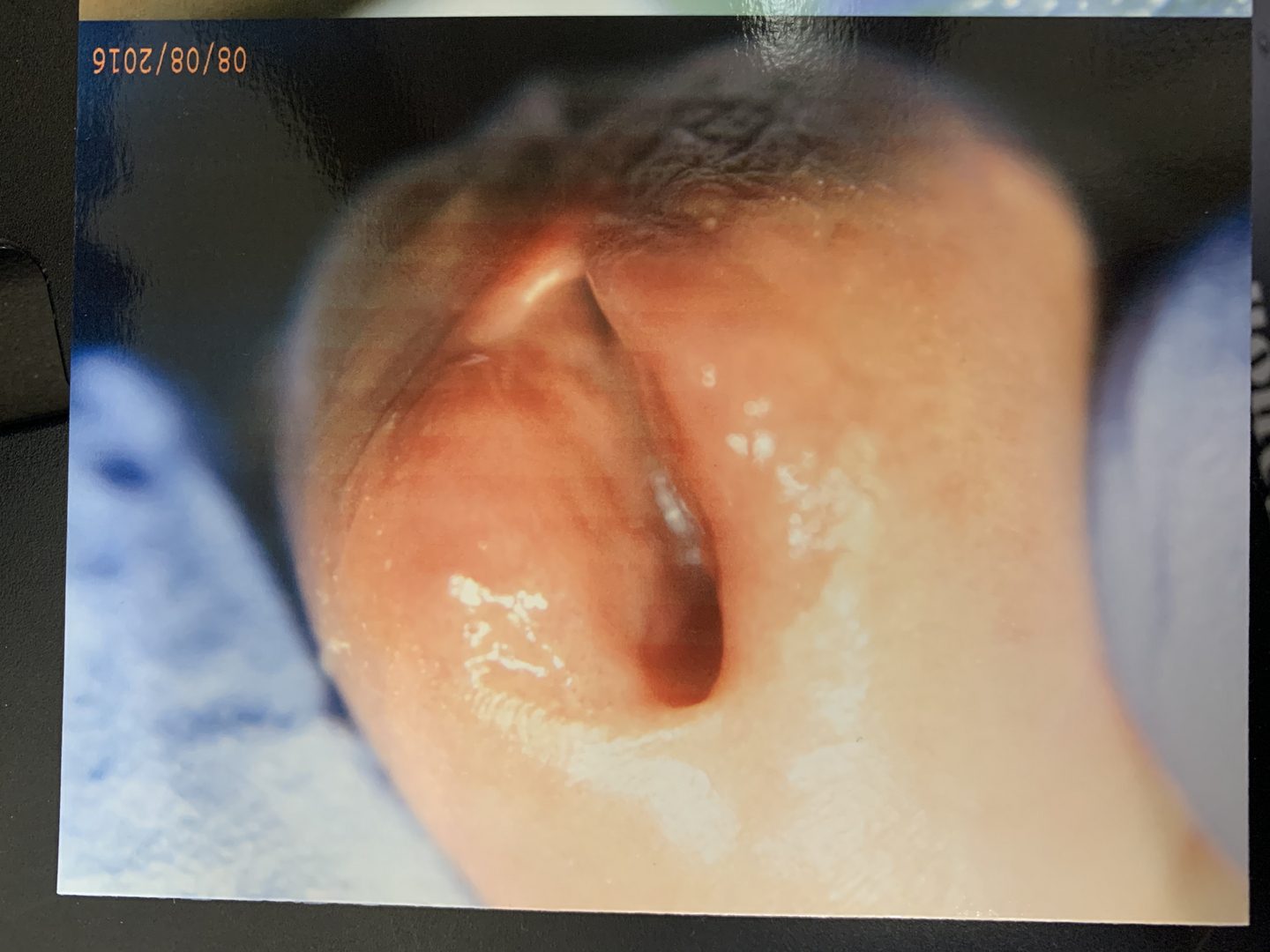 Urethral HPV Warts & Tumors – photo 6