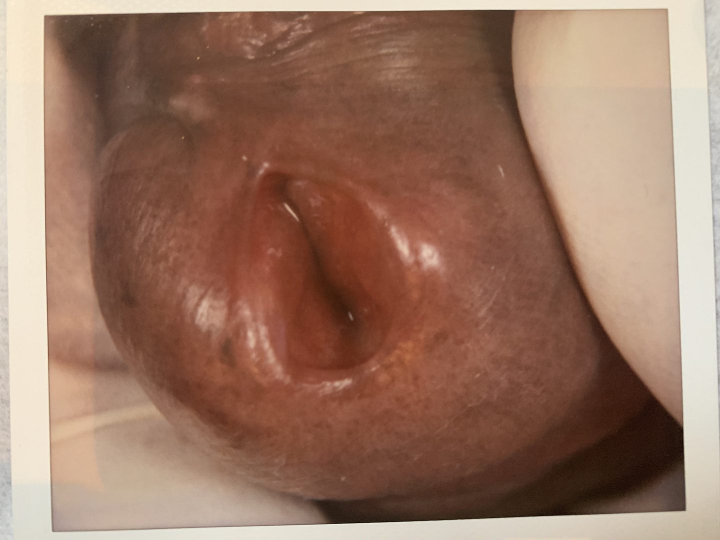 Urethral HPV Warts & Tumors – photo 7