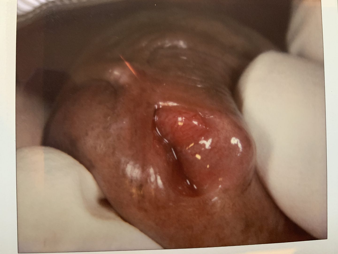 Urethral HPV Warts & Tumors – photo 8