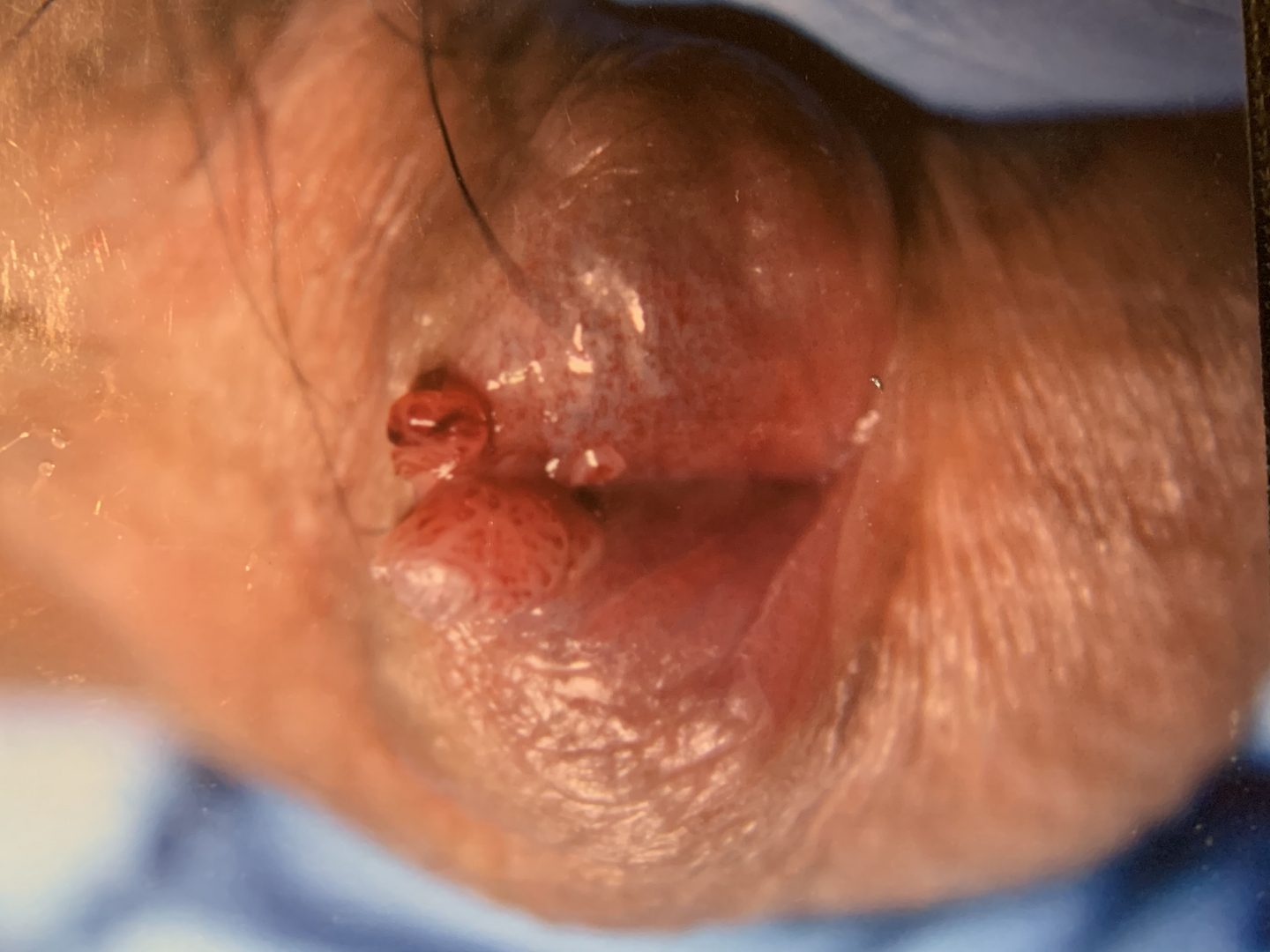 Urethral HPV Warts & Tumors – photo 9
